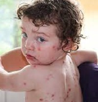 Chickenpox and Emu Oil