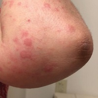 Covid Rash and Emu Oil