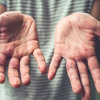 Hand Foot and Mouth Disease and Emu Oil
