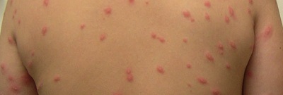 Swimmers Itch